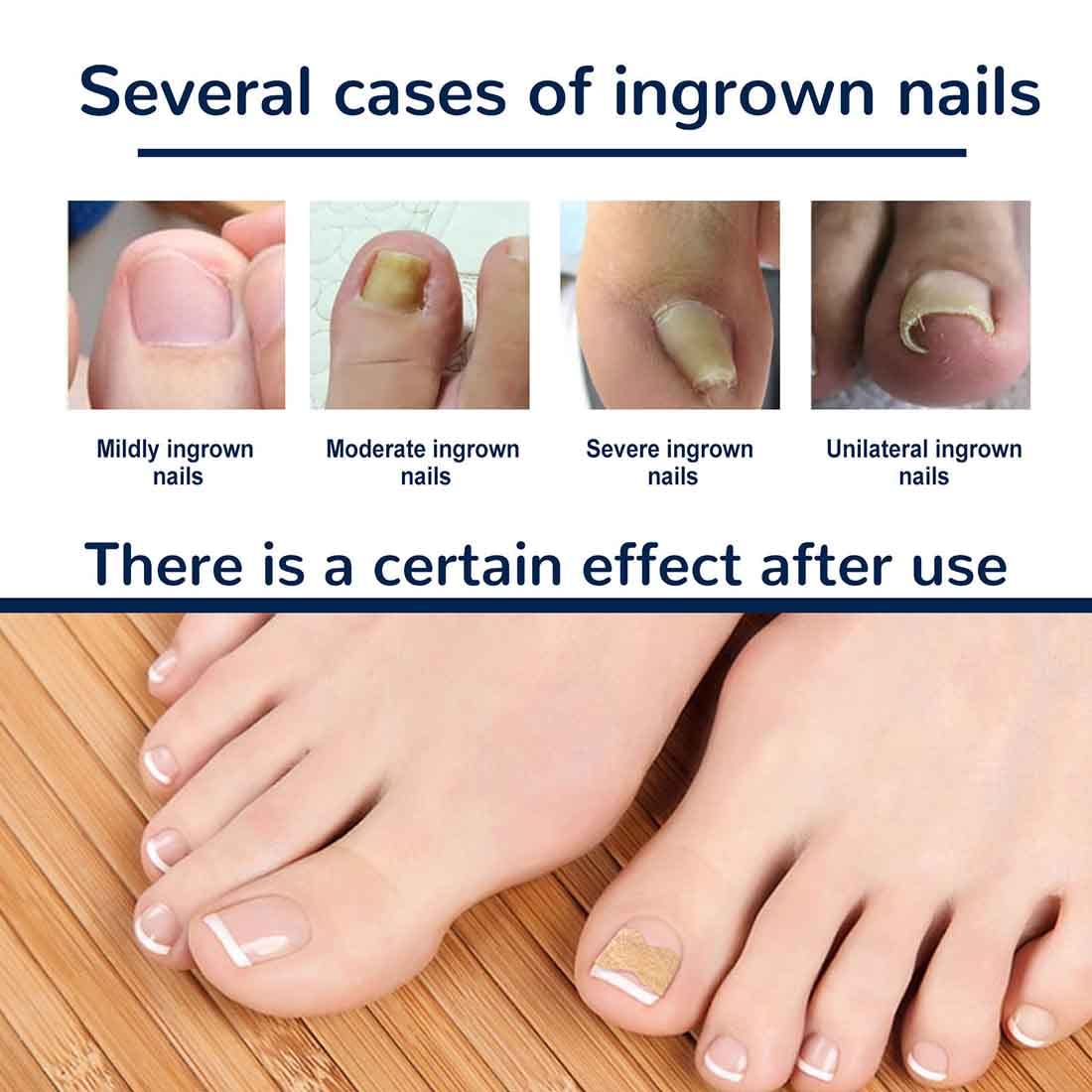 Ingrown Toe Nail Correction Sticker, Toenail Correction Patch, Painless Pedicure Tools, Pack of 50