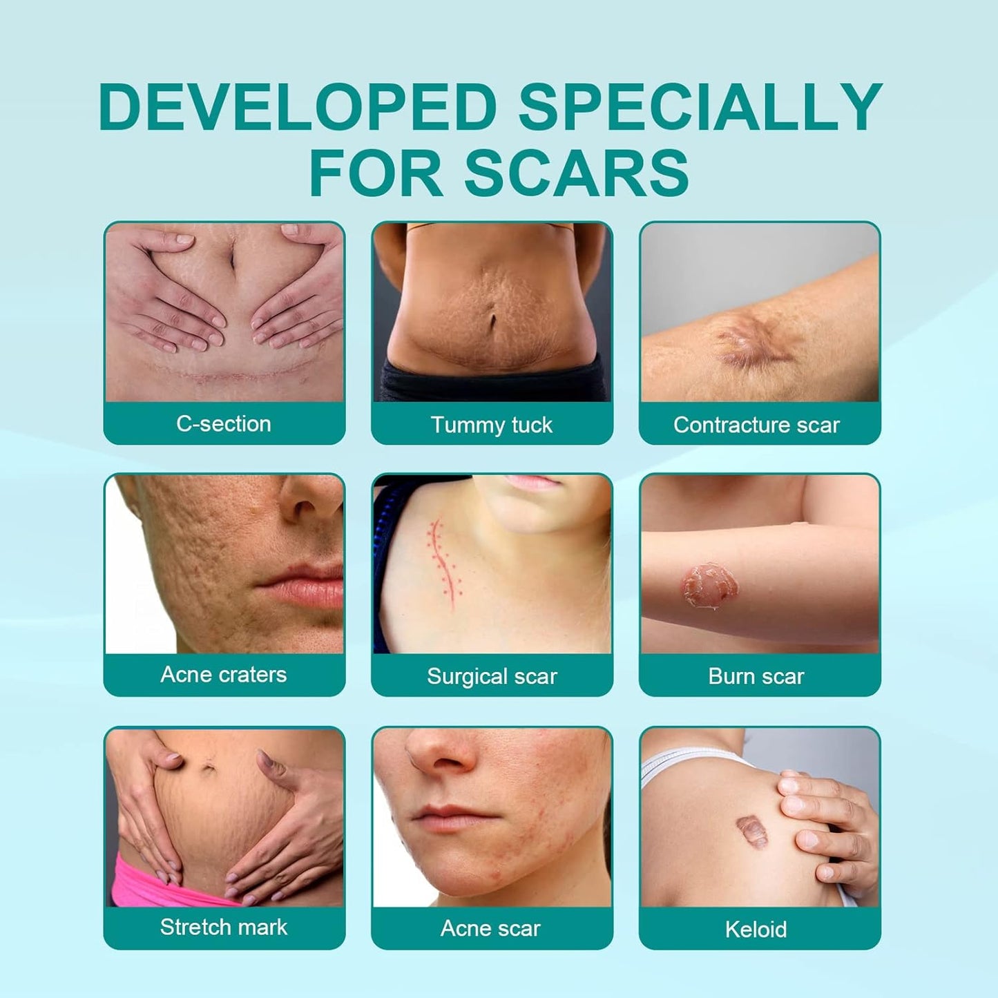 Medical Grade Scar Spray, Scar Remove Medical Grade Scar Spray, Scar Remove Advanced Scar for All Types of Scars (20g)