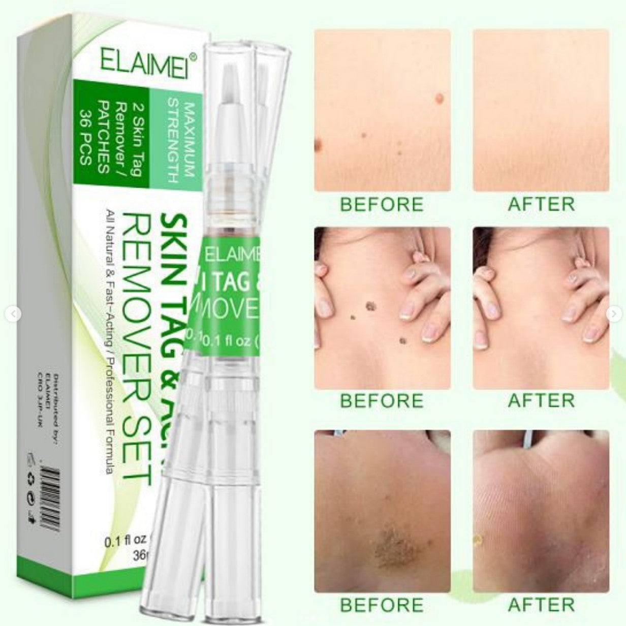 Skin TAG Remover Pens & Patches