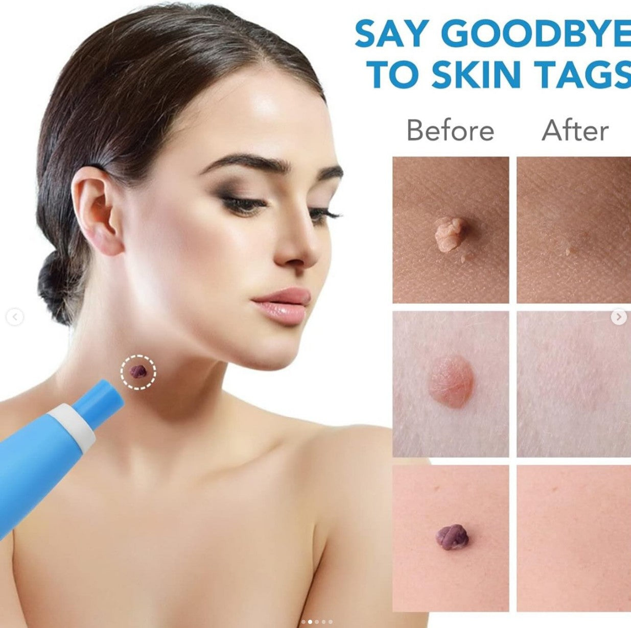 Skin Tag Remover Kit