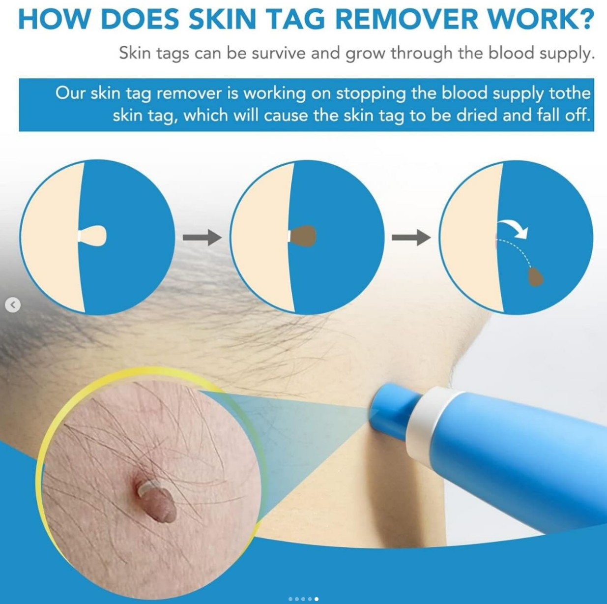 Skin Tag Remover Kit